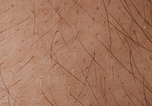 Wat is de connectie tussen je darmgezondheid en huidproblemen zoals acne en eczeem